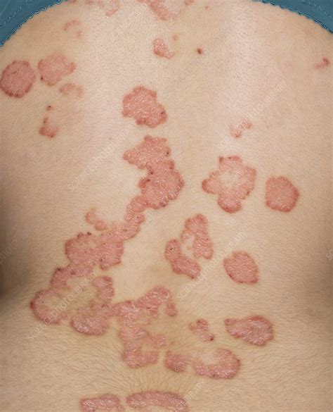 Psoriasis on the back before treatment - Stock Image - C014/2541 - Science Photo Library