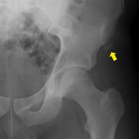 Anterior Superior Iliac Spine Muscle Attachment