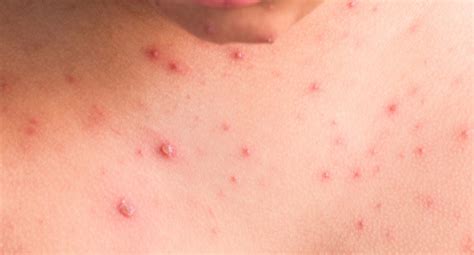 Rashes from Tick Bites – Diagnosis, Consequences and Remedies ...