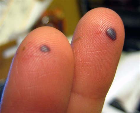 5 Things you may not have known about blood blisters