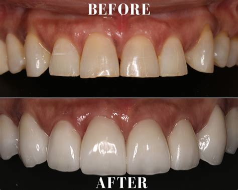 Dental Surgery Veneers at Linda Ekstrom blog