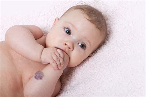 Vascular Birthmarks Awareness Day - May 15, 2024 | Spirit Of The Holidays