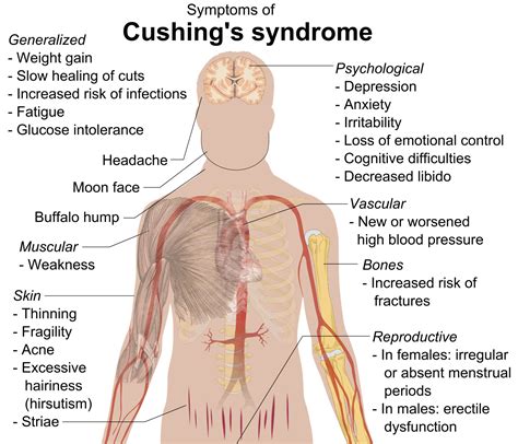 Cushing's Syndrome - almostadoctor