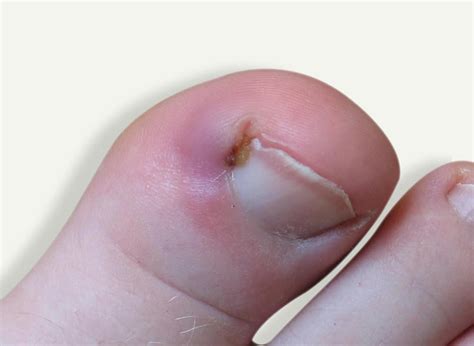 Ingrown Toenail - Davenport House Clinic