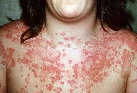 Allergic reaction anaphylaxis rash - DX2 Training Solutions