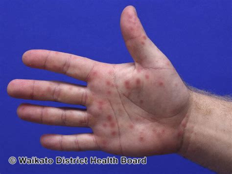 Hand Foot and Mouth Disease — Charlotte Dermatology, P.A.