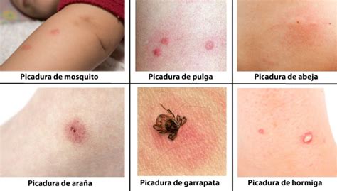 "🕷️ Picaduras de Arañas: Tipos, Síntomas, Tratamientos y Prevención🏥