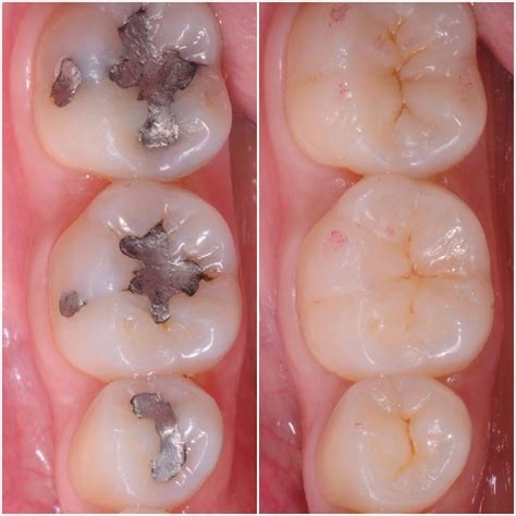 Pin on Dental Conditions