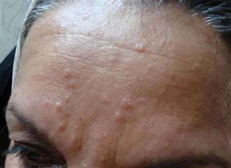 Sebaceous Hyperplasia - Treatment, Photos, Removal, Causes