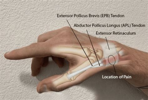 Thumb-Sided Wrist Pain in Climbers: A Case for De Quervain’s Tenosynovitis - The Climbing Doctor