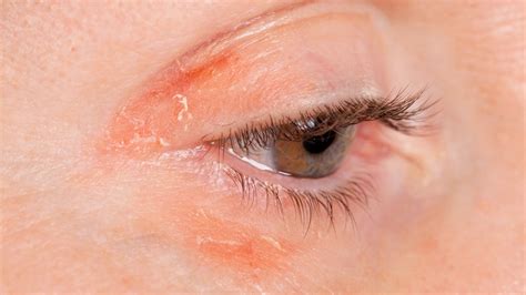 Rashes Around The Eye | Renew Physical Therapy