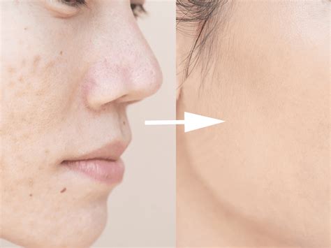 Sebaceous Filaments: How to get rid of them - Skinglow Clinic