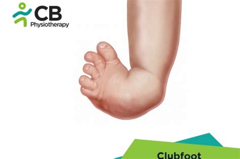 top-5-exercises-for-clubfoot-or-congenital-talipes.webp