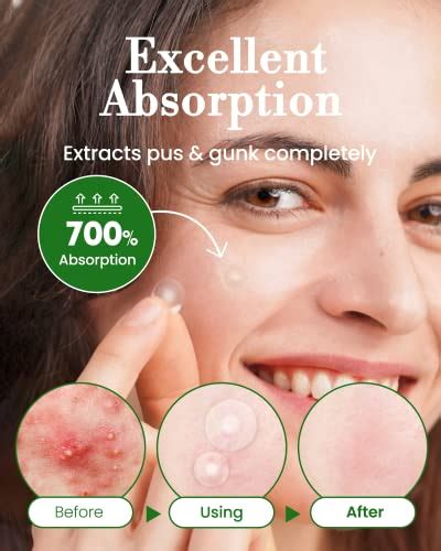 Troubless Invisible Pimple Spot Patch - Signature, Hydrocolloid Acne ...