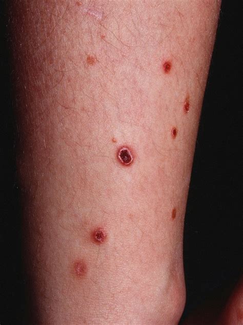 Pityriasis rosea differential diagnosis - wikidoc