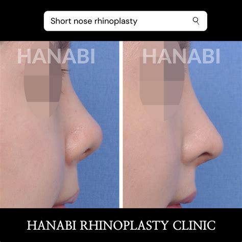 Short nose rhinoplasty (5) – HANABI RHINOPLASTY CLINIC