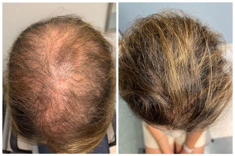 Minoxidil: remédio é o melhor para combater a calvície, dizem médicos; veja antes e depois ...