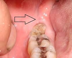 Wisdom Tooth Remol Normal Healing Images - voperbloom