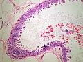 Flat epithelial atypia - Libre Pathology