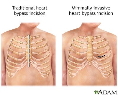 Heart bypass surgery Information | Mount Sinai - New York