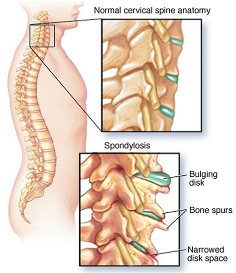What Is Spondylosis? - Spondylosis Treatments, Causes & Symptoms | Cervical spondylosis ...