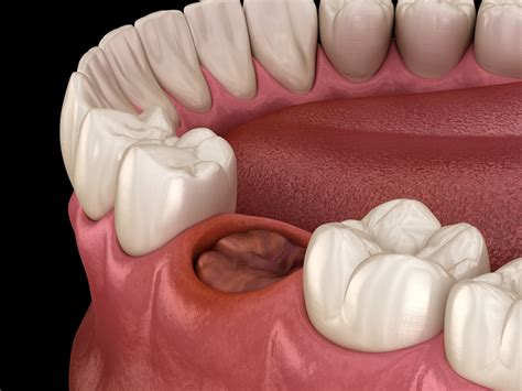 What is Dry Socket? Causes, Pictures, & Treatment