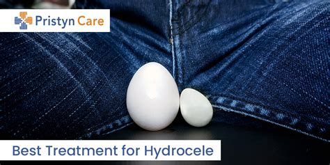 Best Treatment for Hydrocele - Pristyn Care