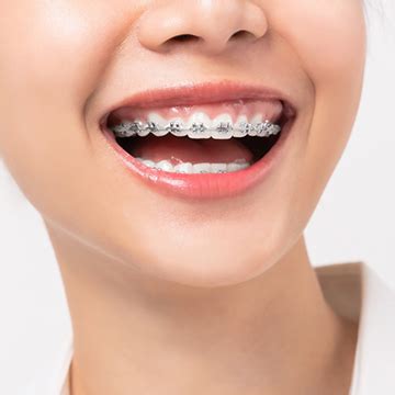 Clear Braces in Beverly Hills, CA | Clear Braces Near You