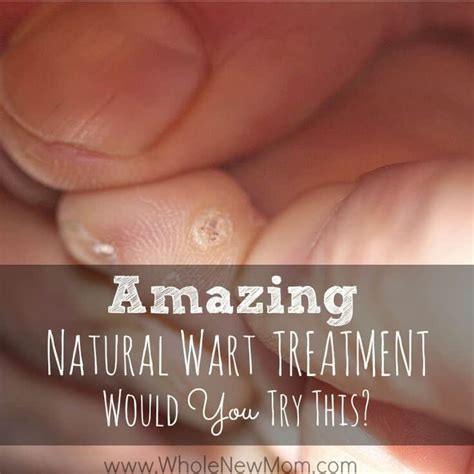 Natural Remedies for Warts {& an Unbelievable One!} | Whole New Mom