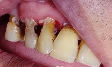 Intraoral photo showing mesial caries on 15, 13, 12 and 11 | Download ...