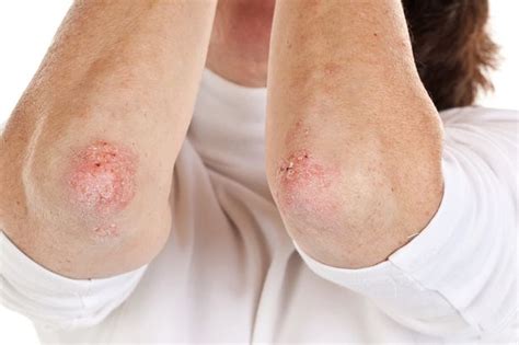 Psoriasis Bumps On Elbows