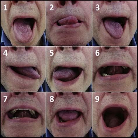 SciELO - Brasil - Long-term functional outcomes and quality of life after partial glossectomy ...