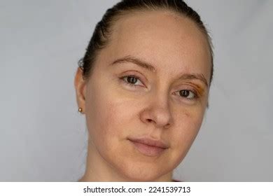 Woman Face Recovery After Plastic Surgery Stock Photo 2241539713 ...