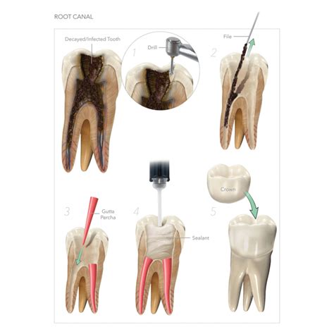 Root Canals - Boston Dental