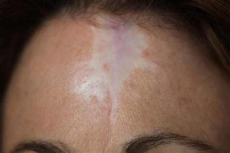 Corrective Procedures: How Micropigmentation Can Camouflage Scars ...