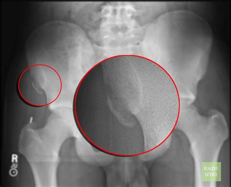 Anterior Superior Iliac Spine Avulsion Fracture (ASIS Avulsion) - radRounds Radiology Network