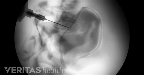 Sacroiliac Joint Injection