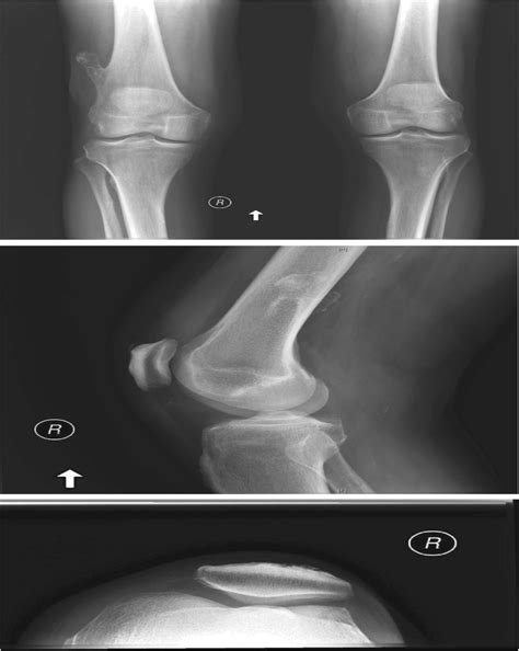 Osteochondroma : Orthopaedic Nursing