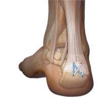 Insertional Achilles Tendonitis Bone Spur Treatment / Achilles ...