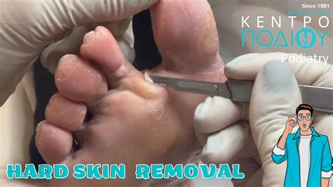 Hard skin removal|Αφαίρεση σκληρύνσεων|Κέντρο Ποδιού|Kentro Podiou ...