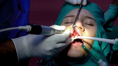 Apicoectomy - Desert Dental Spa