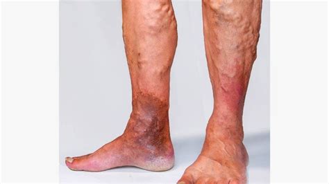 What is the main cause of varicose veins