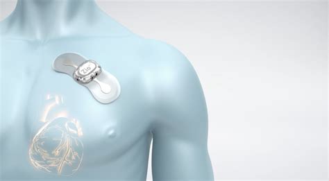 Study: Prompt monitoring with wearable ECG patch more frequently detects undiagnosed a-fib ...