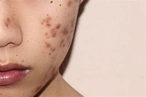 Cystic Acne Scars