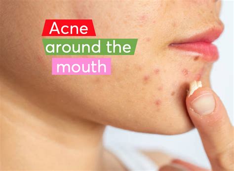 Acne Around The Mouth | MDacne