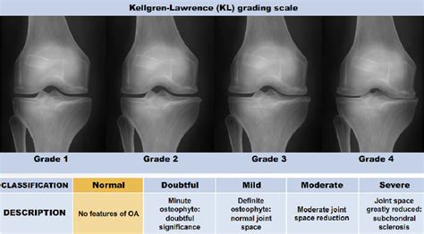 Figure 2 from Quantifying radiographic knee osteoarthritis severity using deep convolutional ...