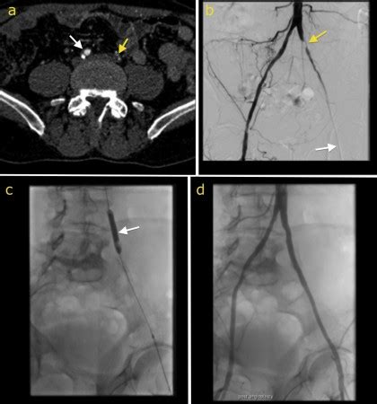 Iliac artery stenting - Radiology at St. Vincent's University Hospital