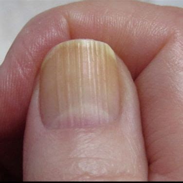 9 Things Your Fingernails Reveal About Your Health | Fingernail health signs, Fingernail health ...