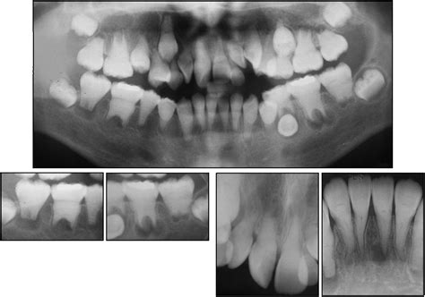 Orthodontic treatment of a patient with dentin dysplasia type I - American Journal of ...