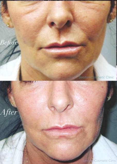 Selston Cosmetic Clinic: Liquid Facelift Treatment Using Botox & Dermal ...